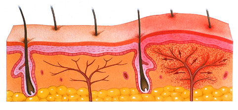 Illustration for inflammation of the skin